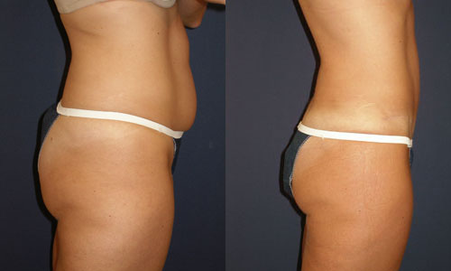 Before and After Image: Patient # 34855 - right-side