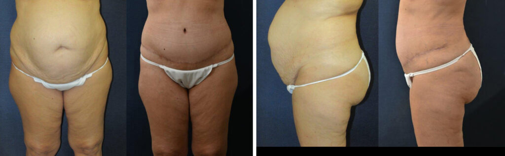 Before and After Image: Patient # 40130 - other