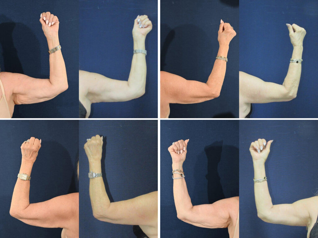 Before and After Image: Patient # 52336 - front