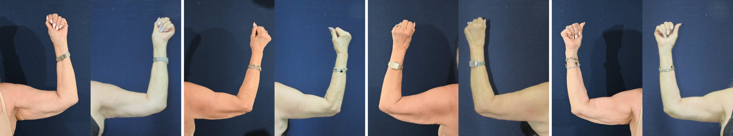 Before and After Image: Patient # 52336 - front