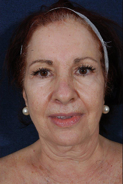 Patient # 67525 Before Photo # 1