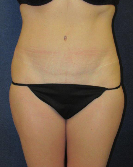 Patient # 23790 After Photo # 2