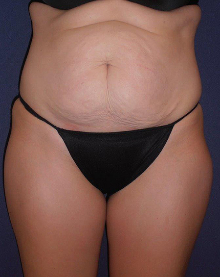 Patient # 23790 Before Photo # 1