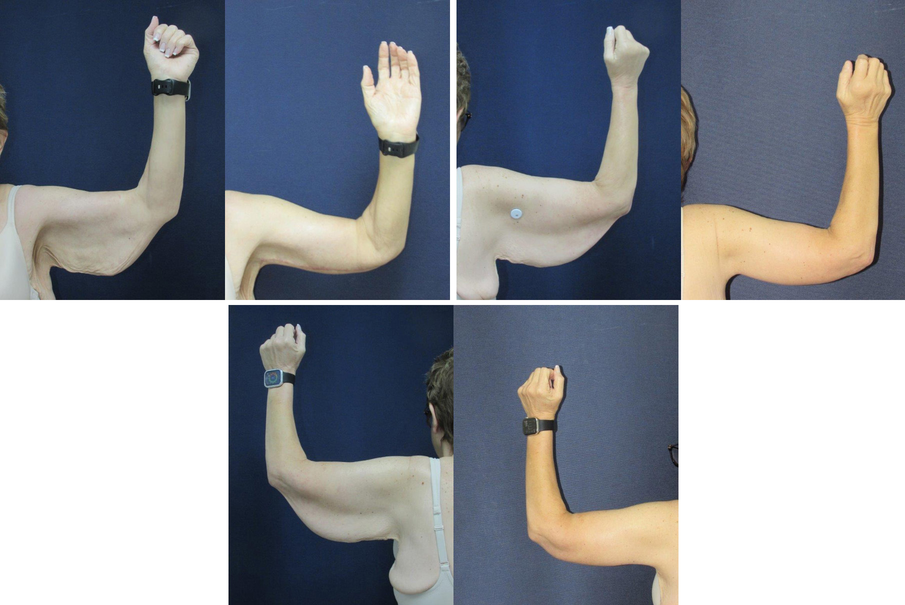 Before and After Image: Patient # 25334 - front