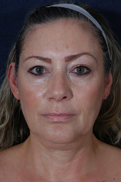 Patient # 62148 Before Photo # 1