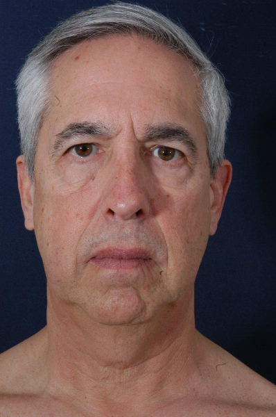 Patient # 24628 Before Photo # 1