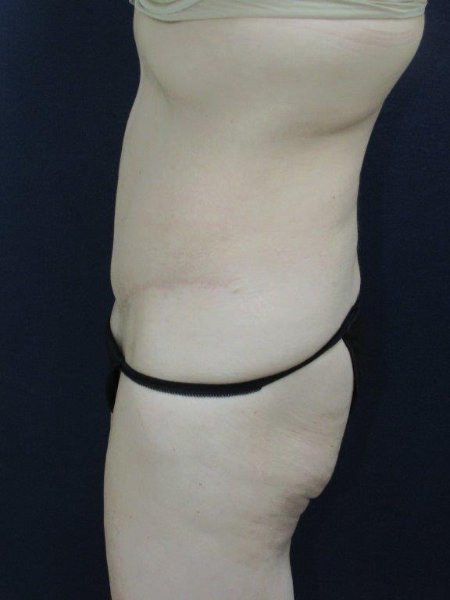 Patient # 87707 Photo 6