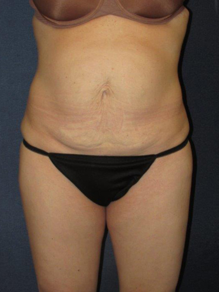Patient # 87707 Before Photo # 1