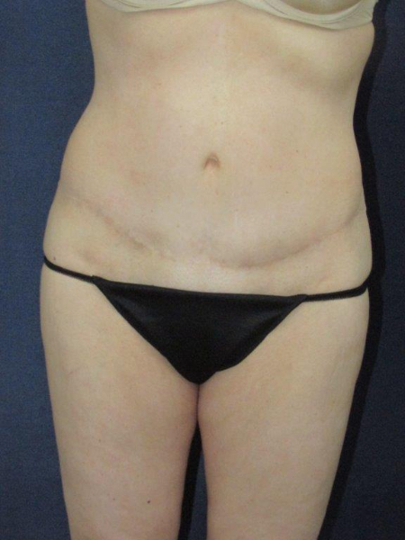 Patient # 87707 After Photo # 2