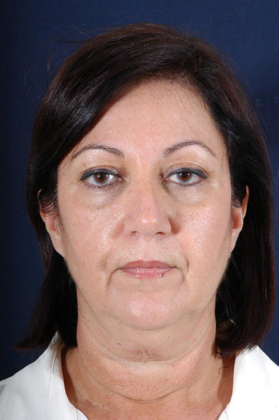 Patient # 17989 Before Photo # 1