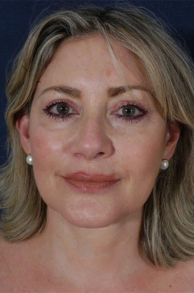 Patient # 62148 After Photo # 2
