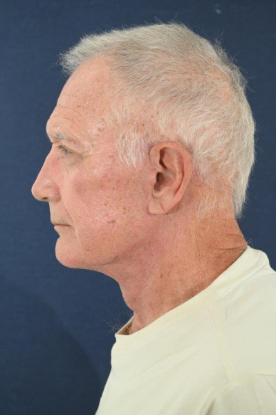 Patient # 75011 Photo 8
