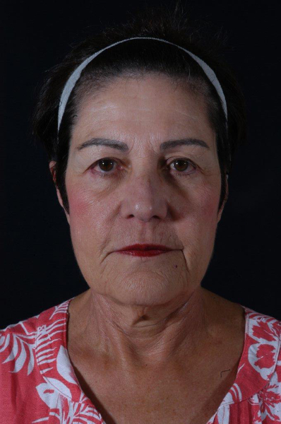 Patient # 58080 Before Photo # 1