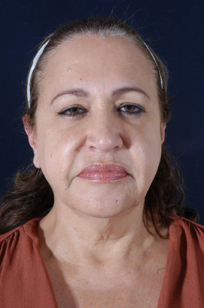 Patient # 51266 Before Photo # 1