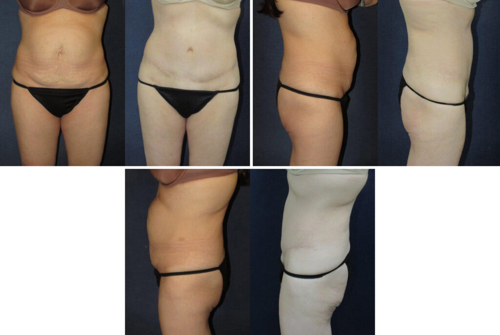 Before and After Image: Patient # 87707 - other