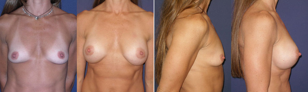 Before and After Image: Patient # 32099 - front