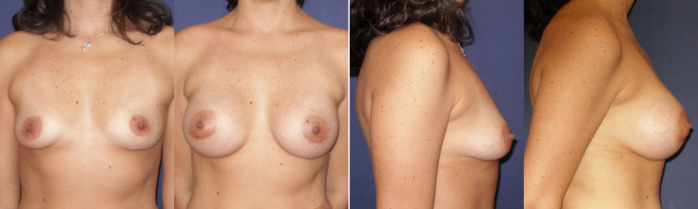 Before and After Image: Patient # 33745 - other