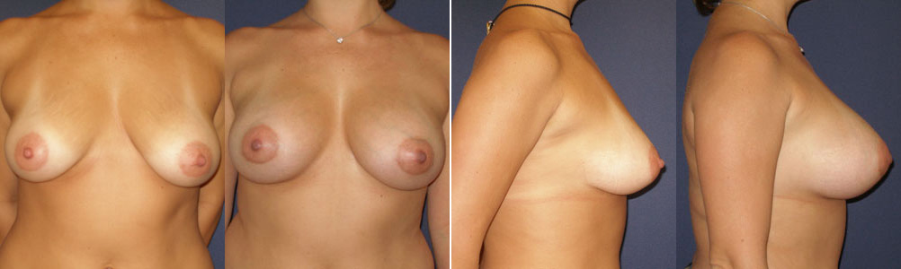 Before and After Image: Patient # 44341 - other