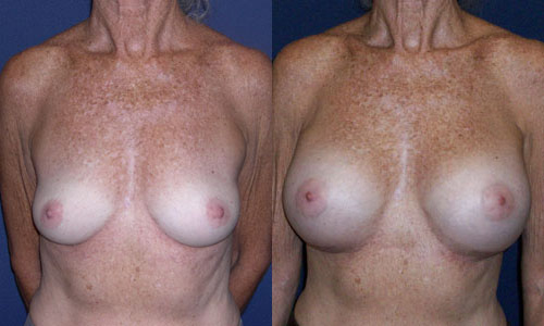 Before and After Image: Patient # 50449 - other