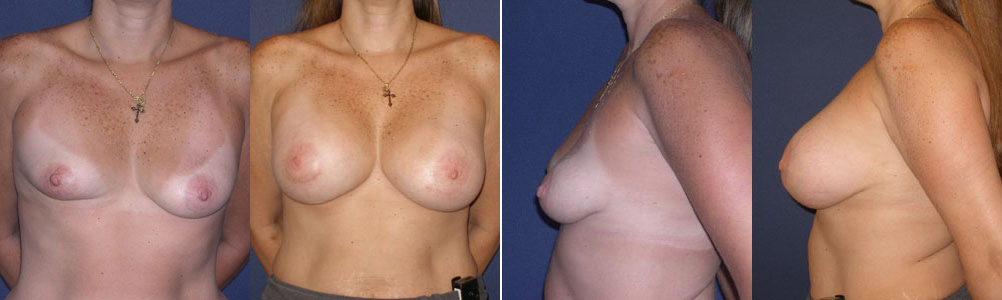 Before and After Image: Patient # 51320 - other