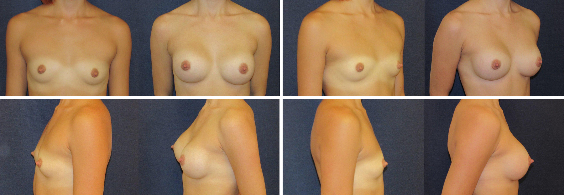 Before and After Image: Patient # 51325 - front