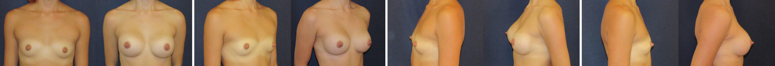 Before and After Image: Patient # 51325 - front