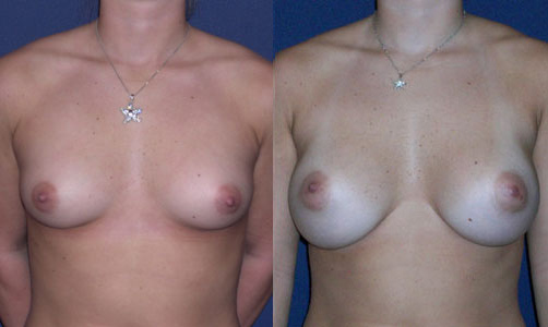 Before and After Image: Patient # 56892 - other