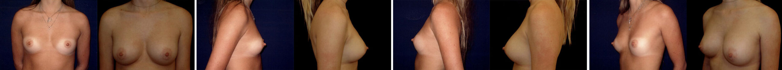 Before and After Image: Patient # 62049 - front