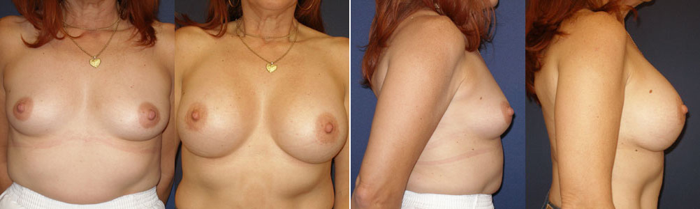 Before and After Image: Patient # 72505 - other