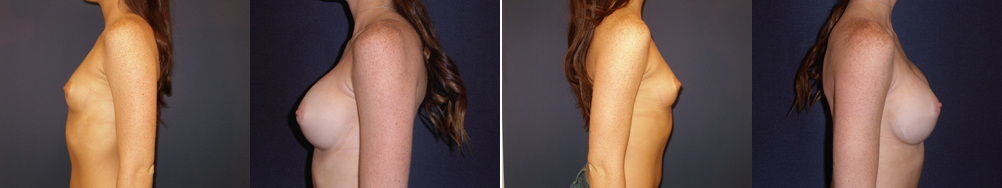 Before and After Image: Patient # 83604 - other