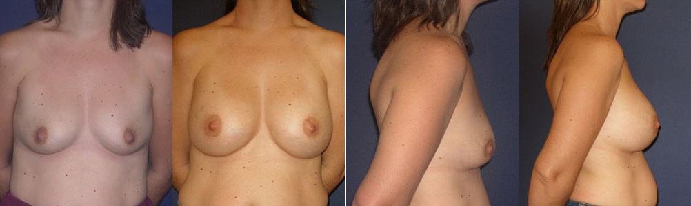 Before and After Image: Patient # 94801 - other