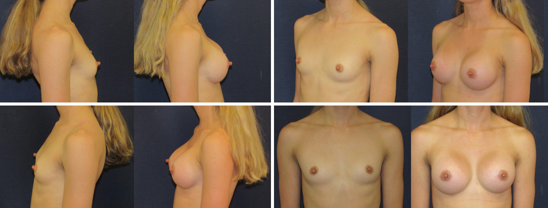 Before and After Image: Patient # 97990 - other