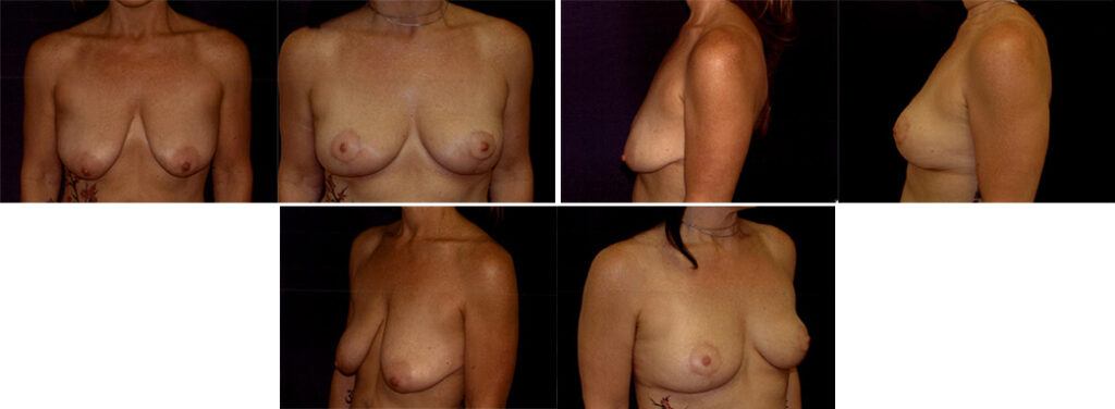 Before and After Image: Patient # 25872 - other