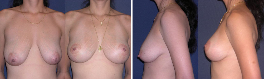 Before and After Image: Patient # 26258 - other