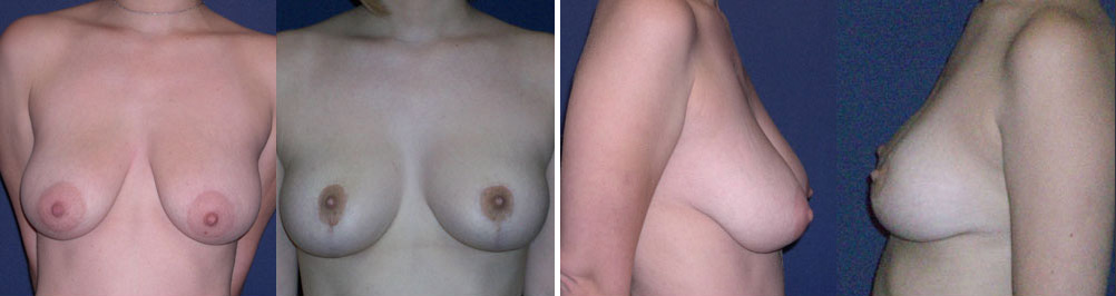 Before and After Image: Patient # 29101 - other