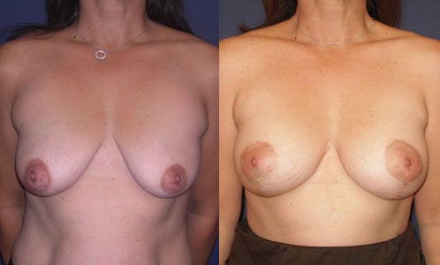 Before and After Image: Patient # 50953 - other