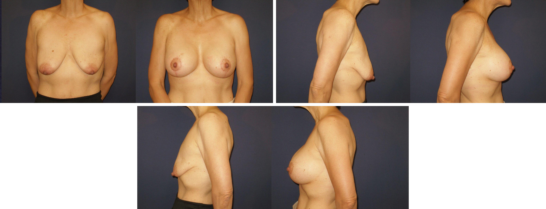 Before and After Image: Patient # 84993 - other