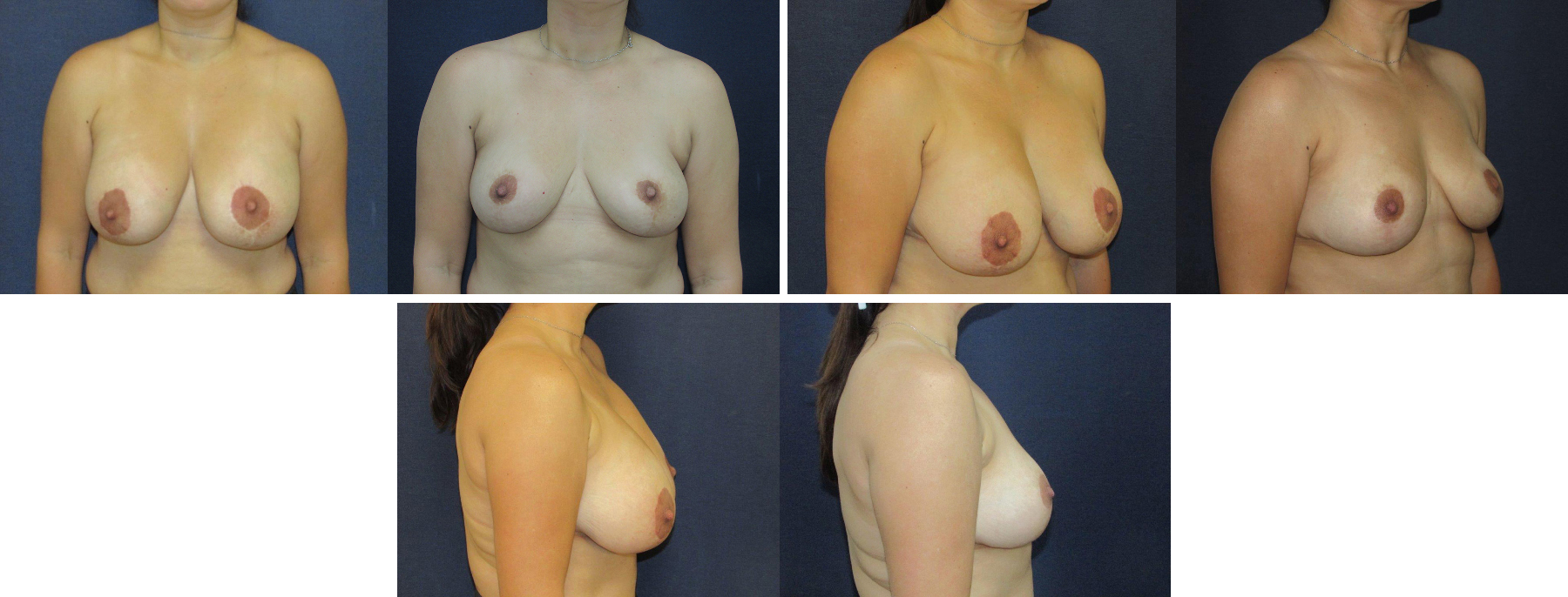 Before and After Image: Patient # 49846 - other