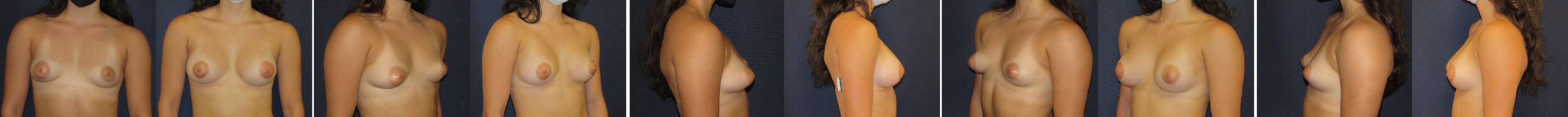 Before and After Image: Patient # 65403 - other