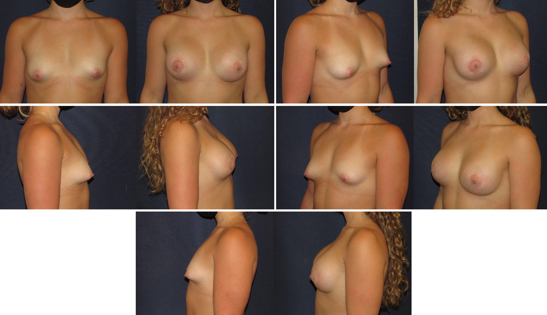 Before and After Image: Patient # 93847 - other