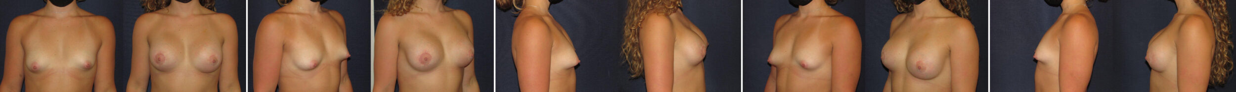 Before and After Image: Patient # 93847 - other