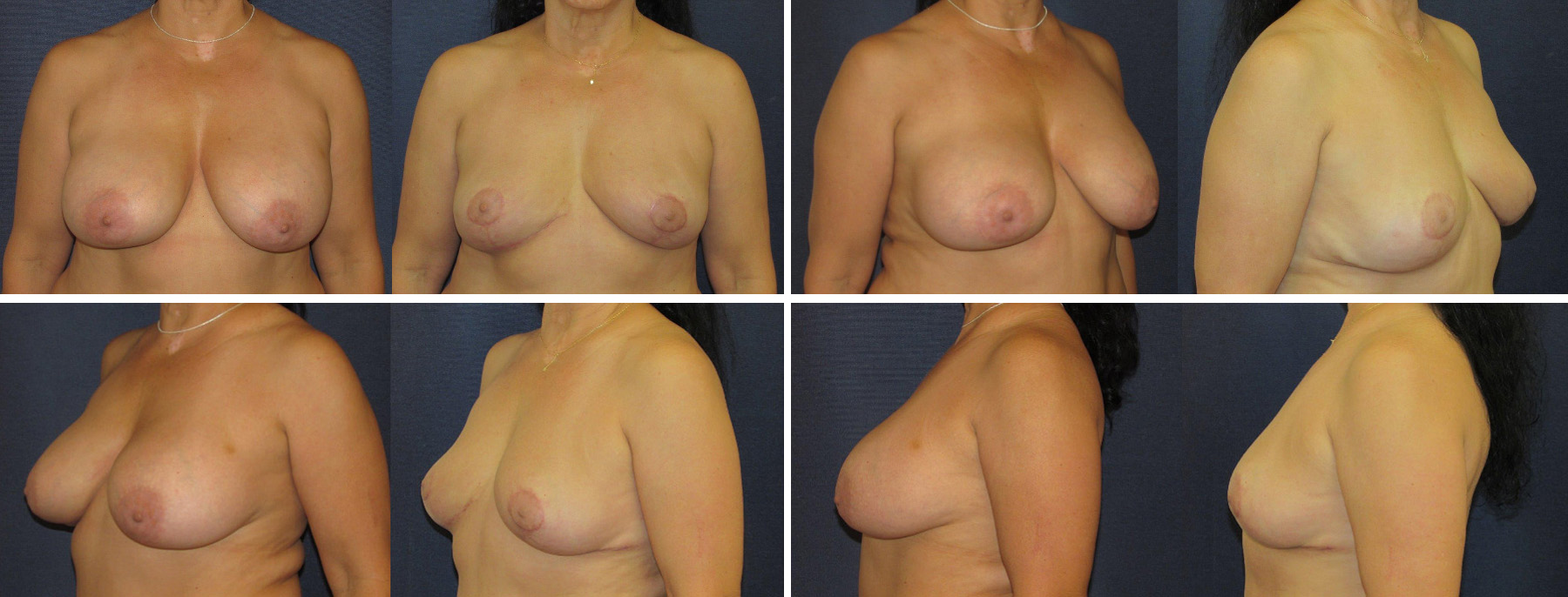 Before and After Image: Patient # 29468 - other