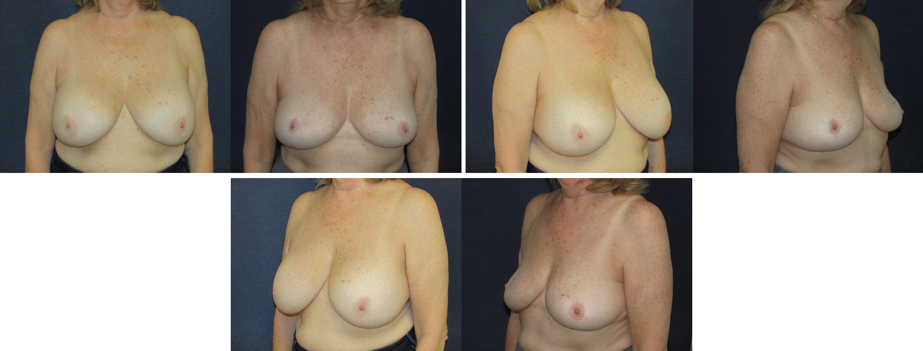 Before and After Image: Patient # 86629 - front