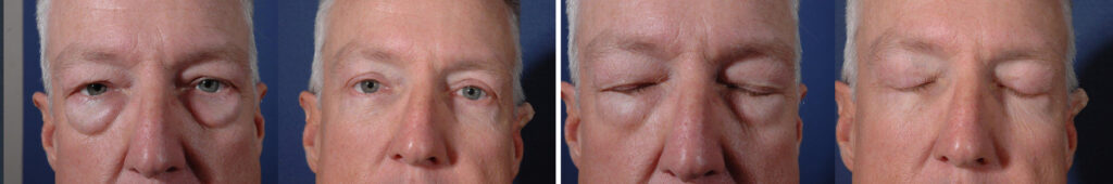 Before and After Image: Patient # 90858 - front