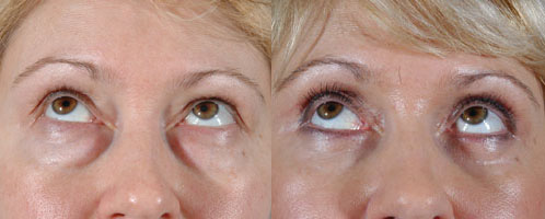 Before and After Image: Blepharoplasty Patient 13920 - front