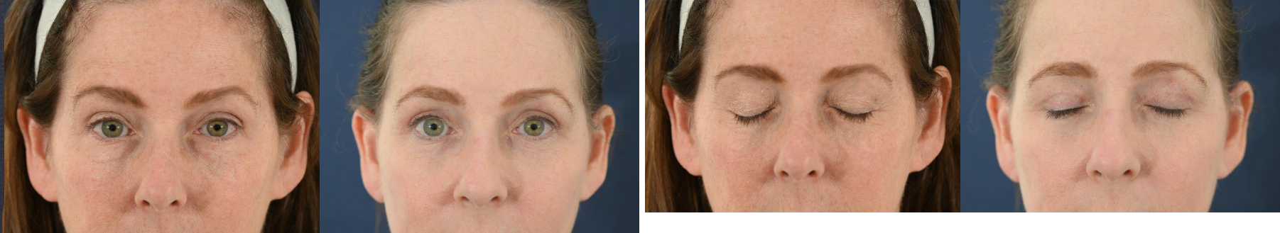 Before and After Image: Patient # 16669 - front