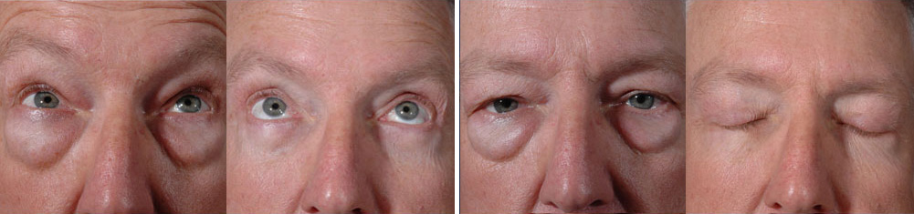 Before and After Image: Blepharoplasty Patient 16727 - front
