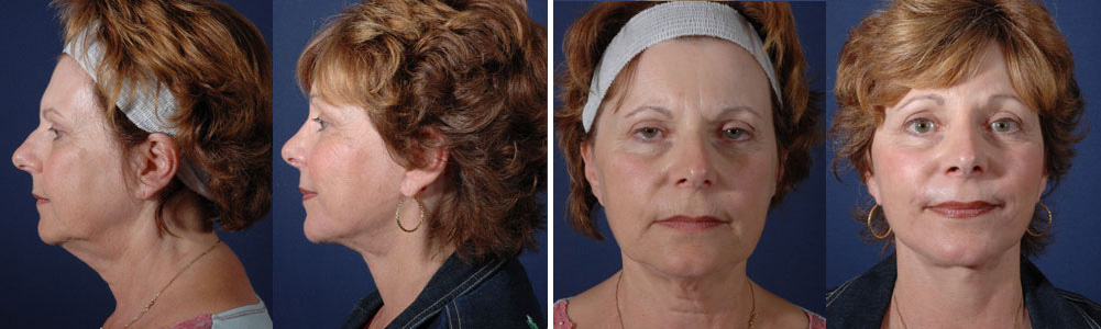 Before and After Image: Patient # 31866 - other