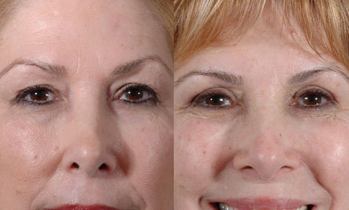 Before and After Image: Patient # 31992 - front