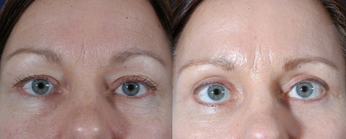 Before and After Image: Patient # 33404 - front